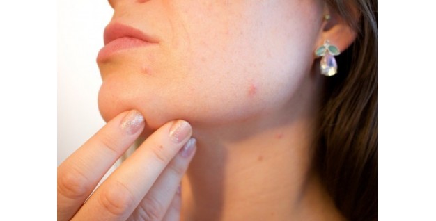 Consejos para solucionar los problemas de acné