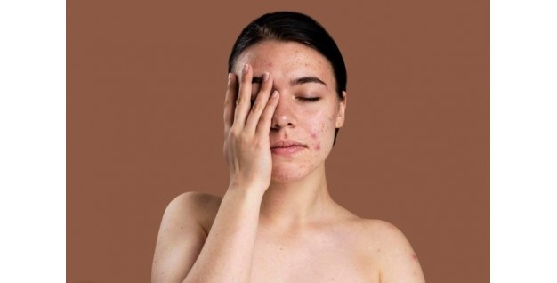¿Cómo tratar y eliminar los poros abiertos de la piel?